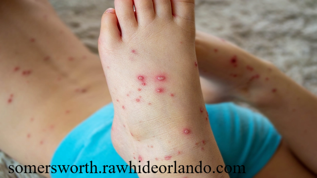 Langkah-Langkah Efektif untuk Mencegah Penyakit Campak