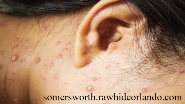 Panduan Lengkap untuk Mencegah Penyakit Cacar